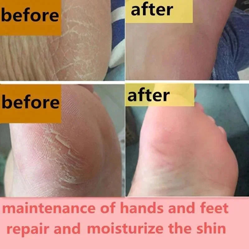 Anti Crack Foot Cream