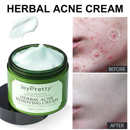 Acne Removal  Face Cream