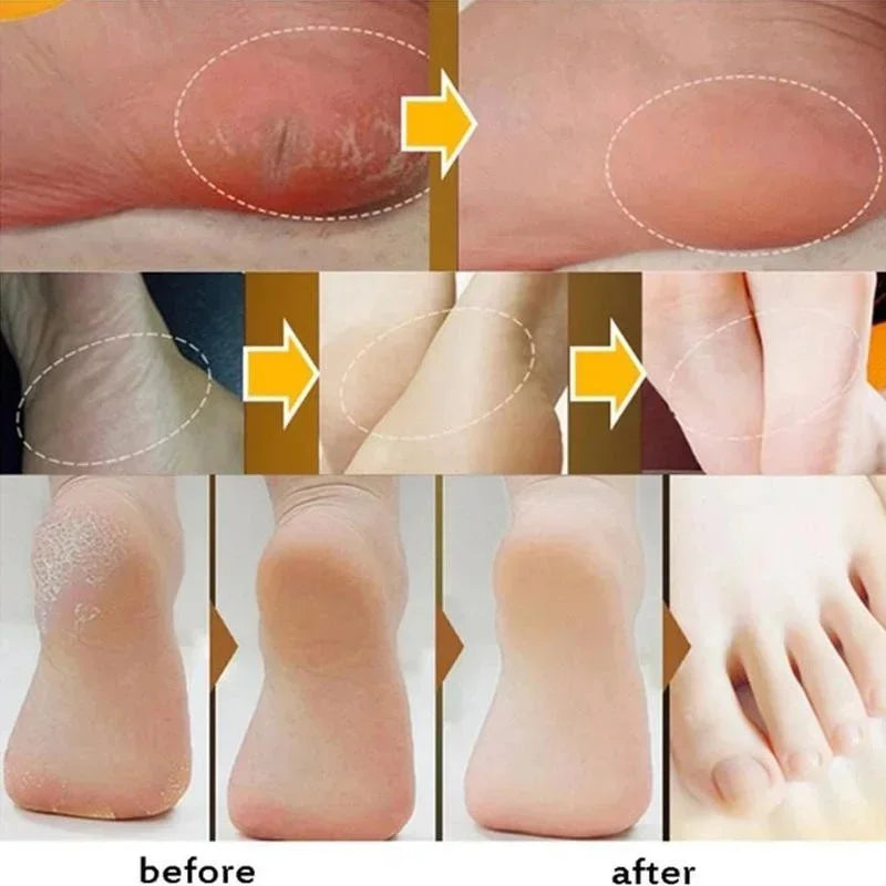 Anti Crack Foot Cream